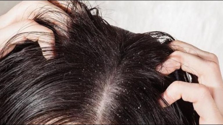 The plane was landed after seeing lice crawling in the hair of a female passenger